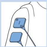 PHILIPS PR3093/00 - Fixation des electrodes et des unités TENS - 6