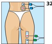 COMPEX MI-SPORT 500 - Douleurs musculaires de la région lombaire (lombalgie) - 1