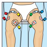 COMPEX MI-SPORT 500 - Compex - 1