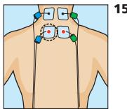 COMPEX MI-SPORT 500 - PlACEMENT des electrodes - 1