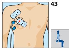 COMPEX MI-SPORT 500 - Placement des electrodes et position du corps - 1