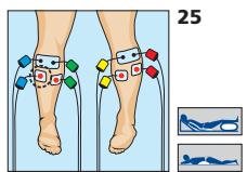 COMPEX MI-SPORT 500 - Placement des electrodes - 1