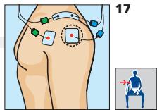 COMPEX MI-SPORT 500 - Placement des electrodes et position du corps - 1