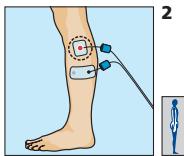 COMPEX MI-SPORT 500 - Placement des electrodes et position du corps - 1