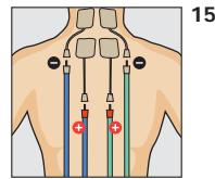 COMPEX THETA STIM - Programme recommende Lombo-sciatalgle - 1