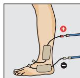 COMPEX THETA STIM - Programme recommende TENS classique - 1
