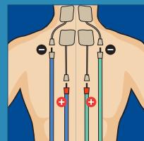 COMPEX THETA STIM - 24