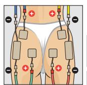 COMPEX THETA STIM - VENTRE - 2