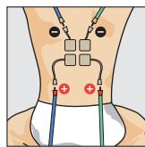 COMPEX THETA STIM - Programme recommende Cervicalgle - 1