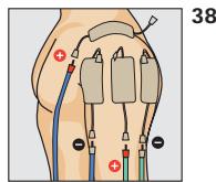 COMPEX THETA STIM - Programme recommende TENS hyperalgle - 1