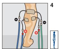 COMPEX THETA STIM - Placement des electrodes et position du corps - 2