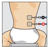 COMPEX THETA STIM - Programme recommende Torticolls - 1