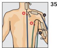 COMPEX THETA STIM - Programme recommende TENS pulsant - 1