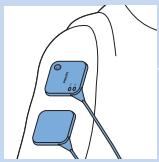 PHILIPS PR3098/00 - Attaching the electrodes and TENS units - 6