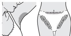 Medical diagram showing surgical placement on pelvic region with labeled anatomical structures
