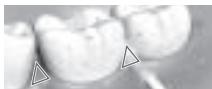 PANASONIC EW1411 - ▶ Limpieza del espacio interdental - 1