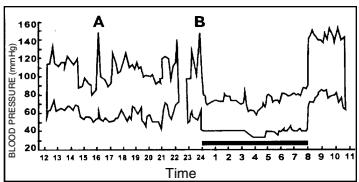 CLATRONIC BDM 2466 - Variations in blood pressure - 1