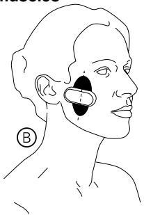 IBP SKEEN PATCH - Position B: Tightening the jaw skin, strengthening the jaw muscles - 1