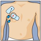 COMPEX MI-FITNESS TRAINER - Grands dômes - 1