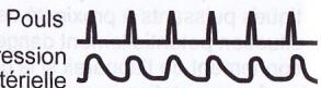 OMRON M3 - Qu'entend-on par pulsations cardiaques irrégulières ? - 1