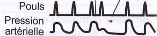 OMRON M3 - Qu'entend-on par pulsations cardiaques irrégulières ? - 2