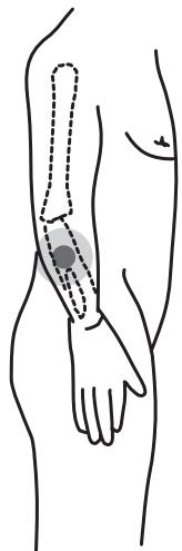 IBP ELECTRO-STIMULATEUR NERVEUX - Douleurs au coude - 1