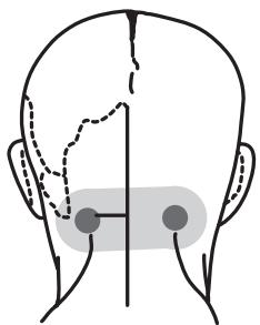 IBP ELECTRO-STIMULATEUR NERVEUX - Douleurs de la nuque - 1