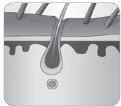 BABYLISS HOMELIGHT G971PE - ■ Wie können Haare durch Licht beseitigt werden? - 5