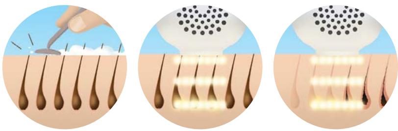 HOMEDICS HM iPL-SLN500K-EU - Préparer la zone à traiter - 1