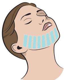 HOMEDICS HM iPL-SLN500K-EU - En mode impulsion lumineuse individuelle (niveau 3, 4 & 5) - 3