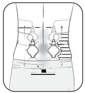 OMRON HeatTens - Étape 1 - placement des électrodes - 1