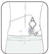 OMRON HeatTens - Étape 1 - placement des électrodes - 3