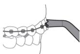 PHILIPS HX3826/31 - Curățarea aparatelor dentare cu capul de curățare Quad Stream - 1