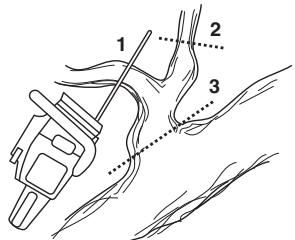 HUSQVARNA 562 XP - Entasten - 1