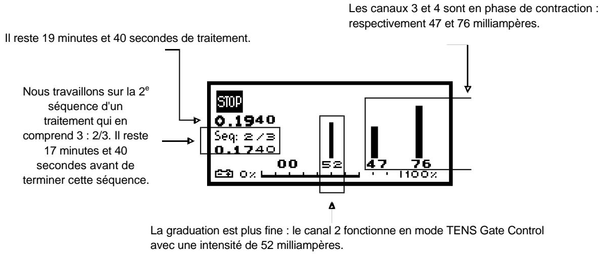 COMPEX -2 - Durant la stimulation : - 1