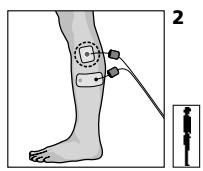 COMPEX MI THETA PRO - Placement des électrodes et position du corps - 1