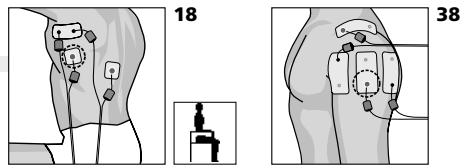 COMPEX MI THETA PRO - Traitement de l'amyotrophie du quadriceps consécutive à une chondropathie rotulienne post-traumatique - 1