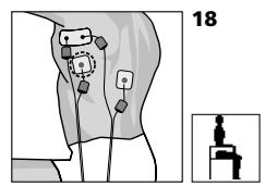 COMPEX MI THETA PRO - Déroulement d'une séance force sur les triceps ("dips"), de type "pyramidal", combinée au programme excentrique: - 1