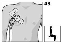 COMPEX MI THETA PRO - Placement des électrodes et position du corps - 1