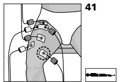 COMPEX MI THETA PRO - Traitement de l'insuffisance du quadriceps consécutive à une sub-luxation externe de la rotule - 1