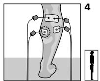 COMPEX MI THETA PRO - Placement des électrodes et position du corps - 1