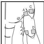 BEURER EM49 - Rapport des électrodes avec le cours des fibres musculaires - 1