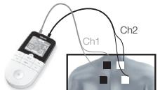 BEURER EM49 - Elektrotlarin konumlandirilmasina yönelik bilgiler - 1