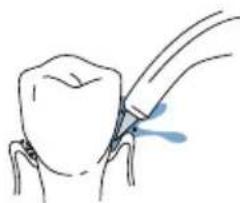 Waterpik Nano Traveler WP300 - Canule Pik PocketMC - 1