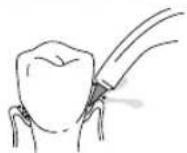 Waterpik WP450 - Embout Pik Pocket - 1