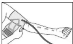 BEURER BM 77 - Positionner la manchette - 2