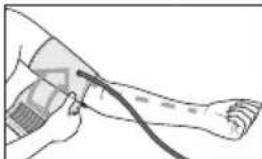 SANITAS SBM 30 - Positioning cuff - 2