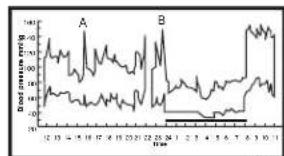 ELTA BM122 - Fluctuations of blood pressure - 2