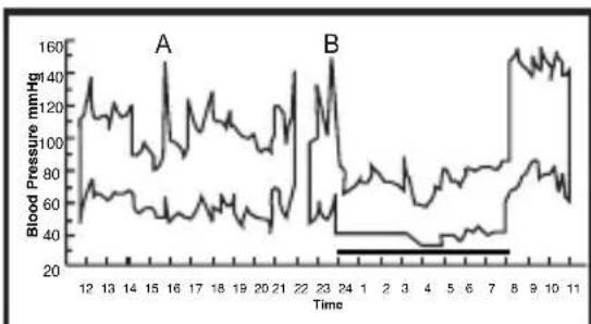 ELTA BM101 - Variations in the blood pressure - 2