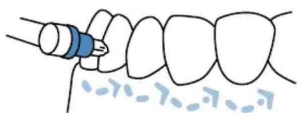 Waterpik Sensonic SR1000 - Using the interdental brush - 1